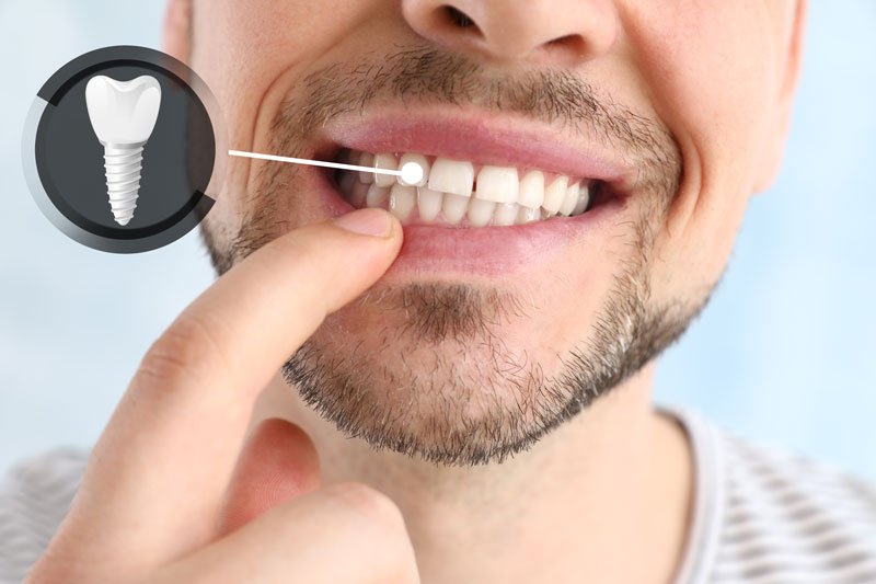 Dental Implants in Lucknow